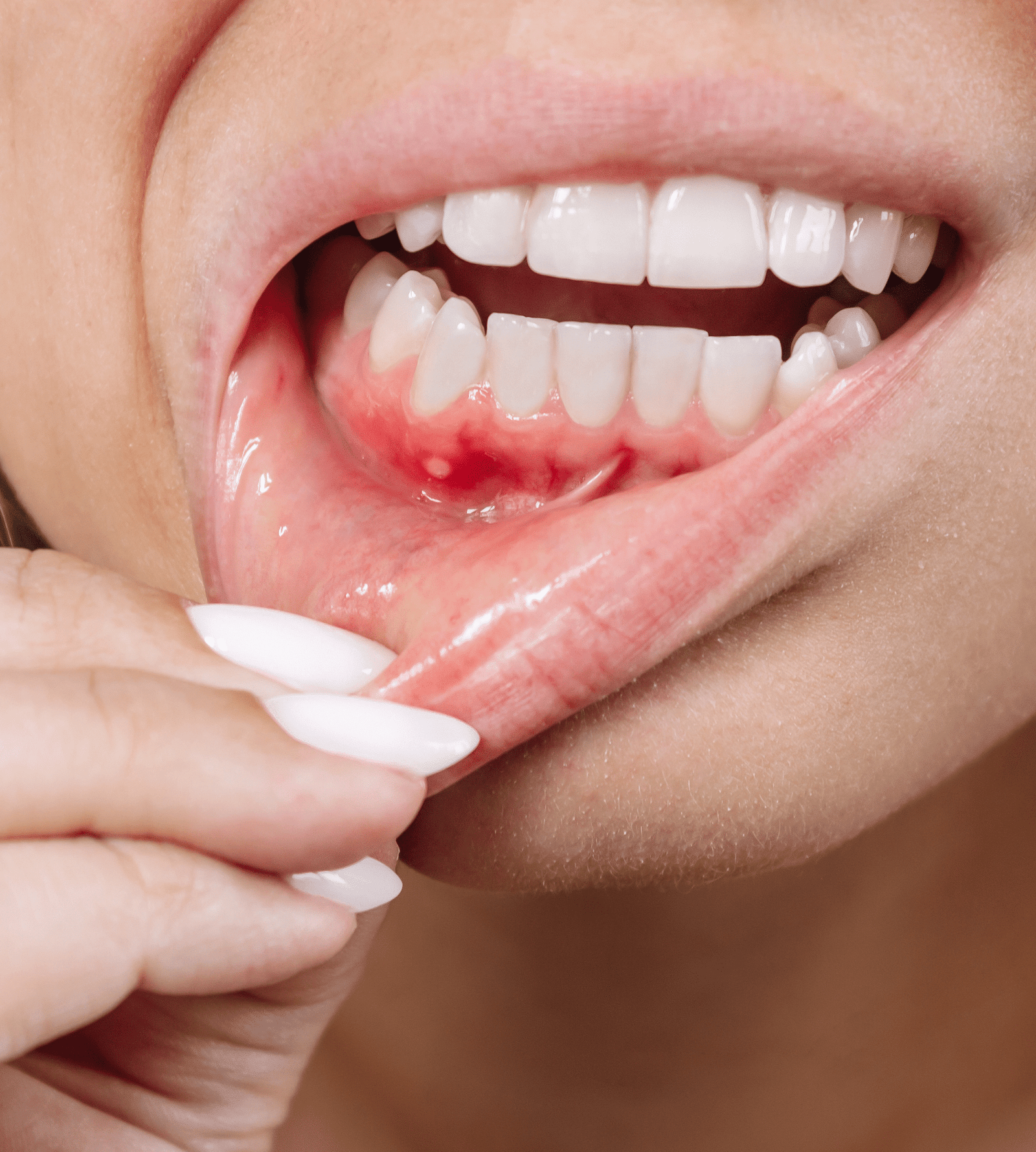 5 Natural Ways to Cure Gum Disease Without a Dentist in Nashville, TN