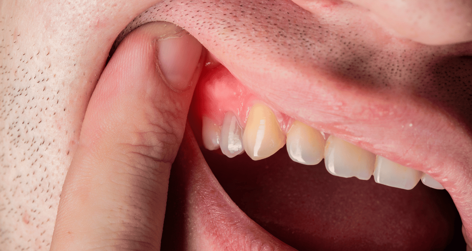 how to cure gum disease (2)