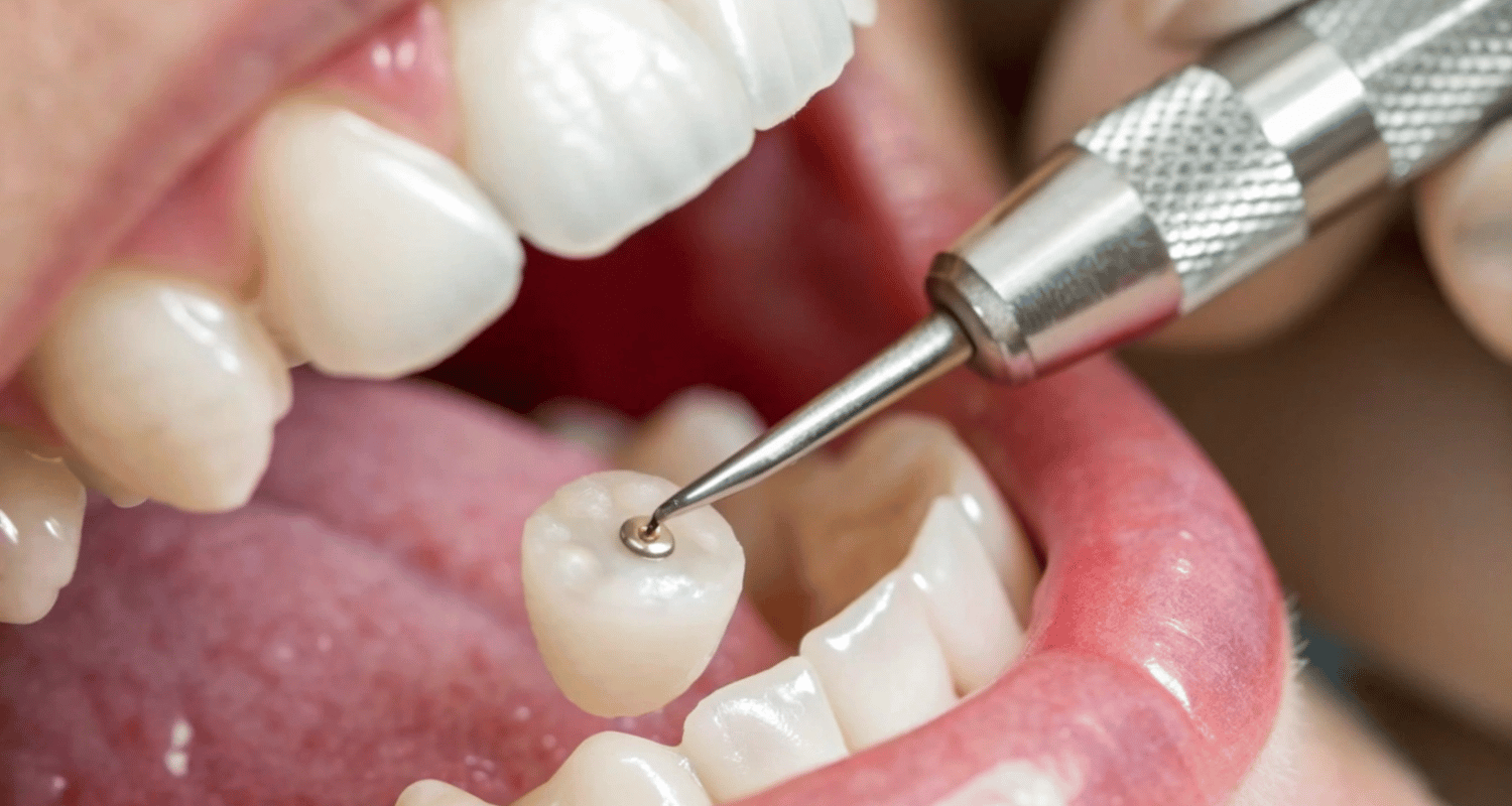 how to remove stains from temporary crowns